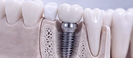 IMPLANTES DENTÁRIOS - DENTISTA JARDIM PERI